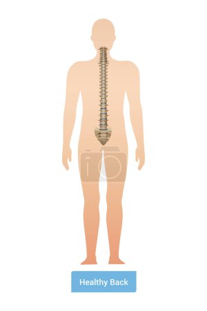 Téléchargez les illustrations : Spinal curvature scoliosis composition with anatomic view of human body silhouette with spine and text vector illustration - en licence libre de droit