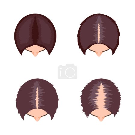 Ilustración de Alopecia composición de trasplante capilar con imagen infográfica de procedimientos de restauración capilar ilustración vectorial - Imagen libre de derechos