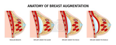 Ilustración de Conjunto de implantes de anatomía mamaria femenina de composiciones aisladas con vistas de perfil de senos y leyendas de texto ilustración vectorial - Imagen libre de derechos