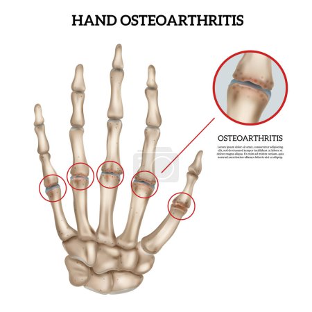 Ilustración de Realista mano osteoartritis anatomía infografía sobre fondo blanco vector ilustración - Imagen libre de derechos