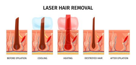 Realistic laser hair removal composition with isolated profile views of scalp during laser removal epilation procedure vector illustration