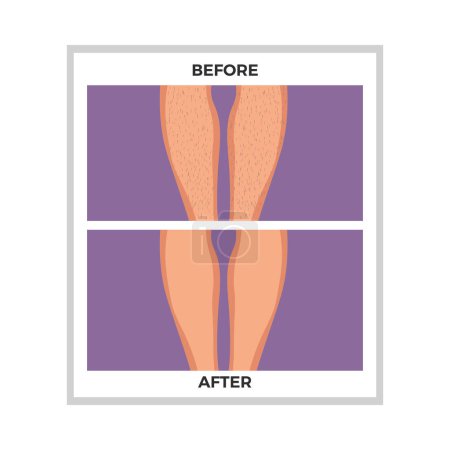 Illustration for Hair removal legs before and after depilation flat vector illustration - Royalty Free Image