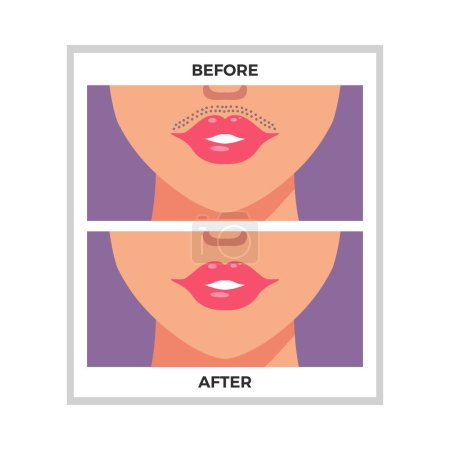 Illustration for Lips area before and after hair removal flat vector illustration - Royalty Free Image