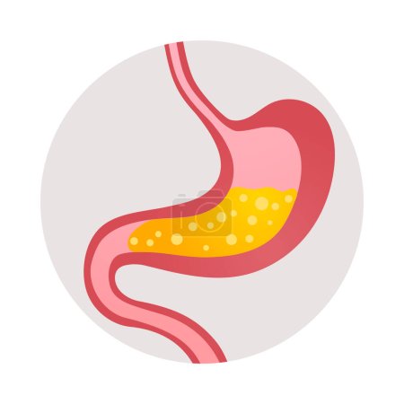 Téléchargez les illustrations : Gastrite brûlure d'estomac symptôme plat icône vectorielle illustration - en licence libre de droit