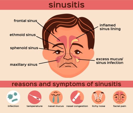 Illustration for Nasal disease flat infographics layout with reasons and symptoms of sinusitis vector illustration - Royalty Free Image