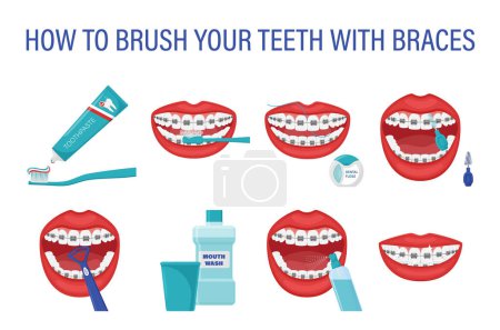 Illustration for Infographic how to brush your teeth with braces. Step-by-step instructions. Oral hygiene. Healthy lifestyle and dental care. Clean white teeth. Prevention of caries. Isolated flat vector illustration - Royalty Free Image