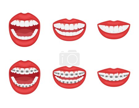 Illustration for Teeth in the mouth with or without braces.Open and closed mouth with red lips. Aesthetic dentistry.Orthodontic treatment during and after. The alignment of the teeth.Healthy lifestyle. Isolated vector - Royalty Free Image