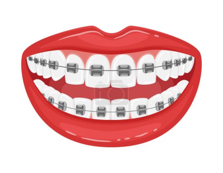 Illustration for Open mouth with braces on the teeth. Straight white teeth with red lips. Orthodontic treatment.Detailed design element for booklets and flyers.Smile. Isolated on white. Flat style.Vector illustration - Royalty Free Image