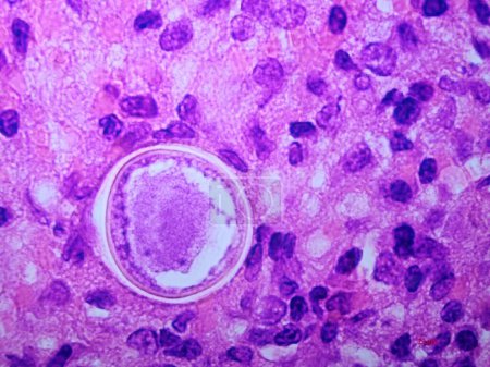 Foto de Coccidioides imitis spherule on tissue biopsy specimen - Imagen libre de derechos