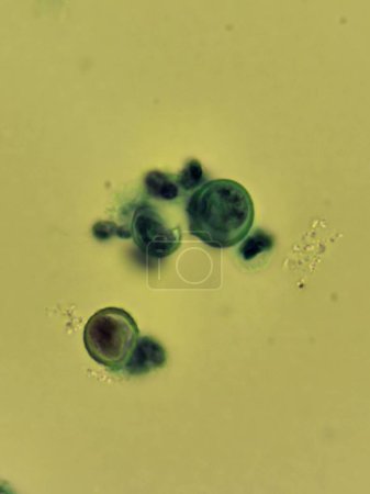 Photo for Blastomyces fungal organisms - skin biopsy specimen - Royalty Free Image