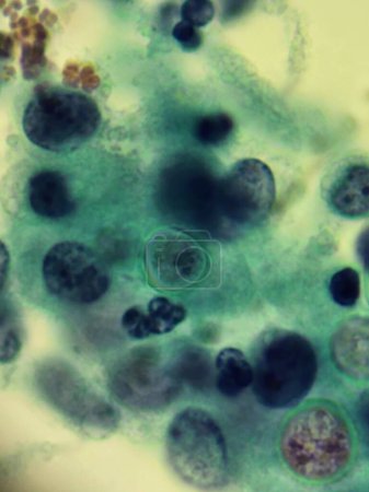 Foto de Blastomyces organismos fúngicos biopsia de la piel espécimen - Imagen libre de derechos