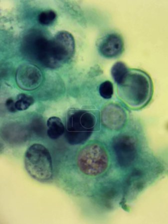 Photo for Blastomyces fungal organisms - skin biopsy specimen - Royalty Free Image