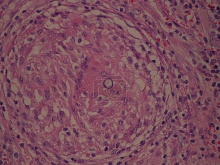 Foto de Coccidioides imitis esférica dentro del granuloma - tinción de tejido - Imagen libre de derechos