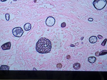 Foto de Coccidioides imitis spherules and endospores on tissue silver stain - Imagen libre de derechos