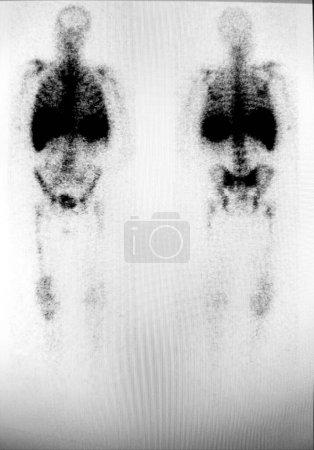 Foto de Indium etiquetado WBC scan - rodilla protésica derecha infectada - Imagen libre de derechos