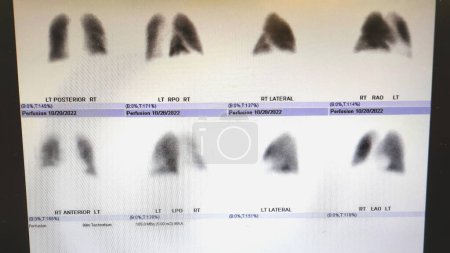 Téléchargez les photos : Médecine nucléaire anormale scan pulmonaire - LLR et embolies pulmonaires antéroobasales - en image libre de droit