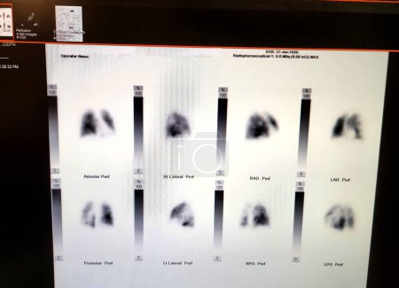 Foto de Medicina nuclear anormal gammagrafía pulmonar: embolias pulmonares RUL y LLL - Imagen libre de derechos