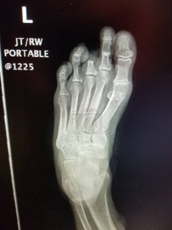 Photo for Left third toe proximal phalanx amputation - plain xray - Royalty Free Image