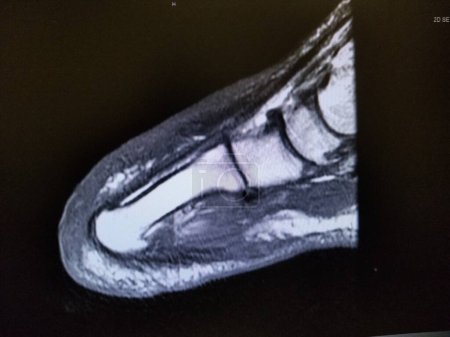 Photo for Left foot transmetatarsal amputation stump - MRI - Royalty Free Image