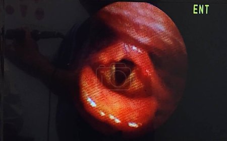Photo for Arytenoids, vocal cords, epiglottis seen through laryngoscope - Royalty Free Image