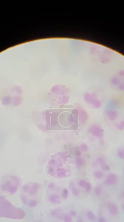 Neisseria gonorrhea sur la tache Gram - diplocoques Gram négatifs intracellulaires