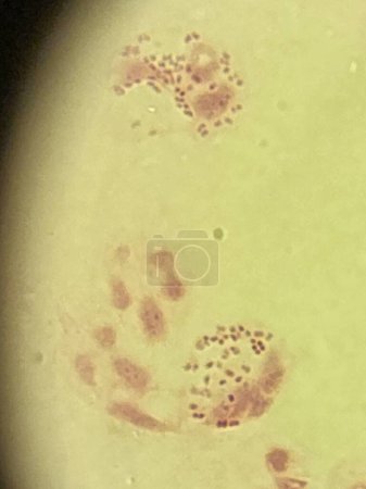 Foto de Neisseria gonorrea en la tinción de Gram - diplococos gramnegativos intracelulares - Imagen libre de derechos