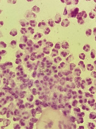 Neisseria gonorrhea on Gram stain - intracellular Gram negative diplococci