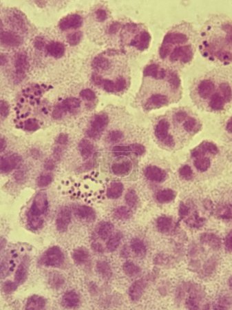 Neisseria gonorrhea on Gram stain - intracellular Gram negative diplococci