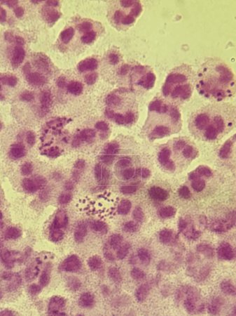 Neisseria gonorrea en la tinción de Gram - diplococos gramnegativos intracelulares