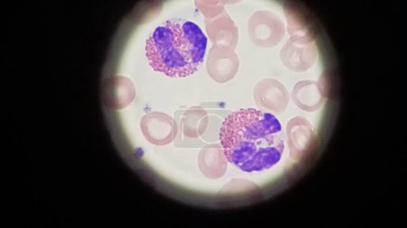 Eosinófilos con glóbulos rojos en frotis de sangre