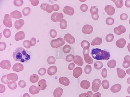 Eosinófilo y neutrófilo en frotis de sangre periférica