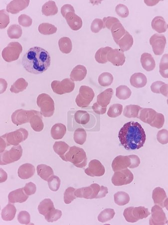 Eosinophil and neutrophil on peripheral blood smear