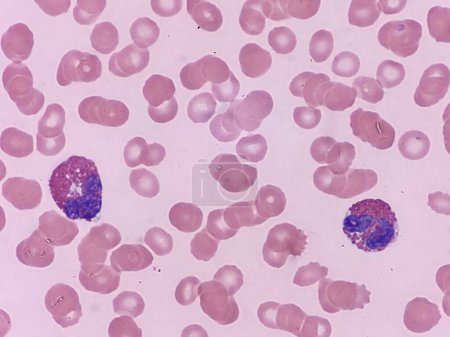 Eosinophils with RBCs on blood smear