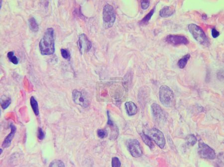 Téléchargez les photos : Inclusions de cytomégalovirus observées sur la lame de pathologie des tissus pulmonaires - en image libre de droit