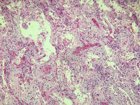 Téléchargez les photos : Inclusions de cytomégalovirus observées sur la lame de pathologie des tissus pulmonaires - en image libre de droit