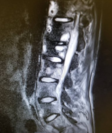 Photo for Coccidioides vertebral osteomyelitis - diagnostic imaging study - Royalty Free Image
