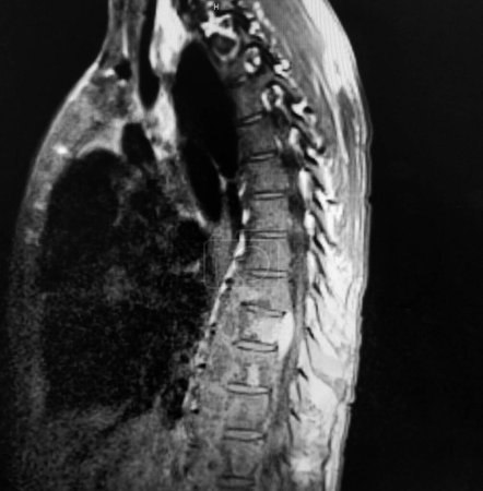 Foto de Osteomielitis vertebral por coccidioides estudio diagnóstico por imágenes - Imagen libre de derechos