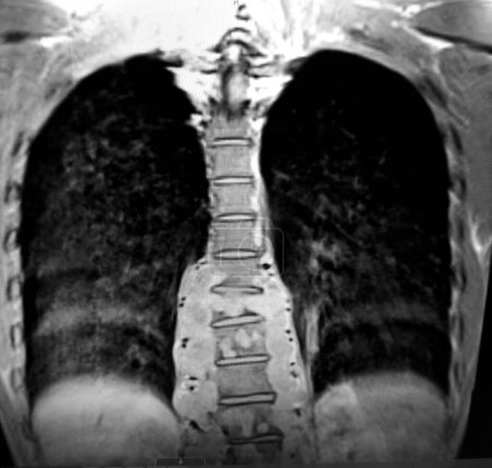 Photo for Coccidioides vertebral osteomyelitis - diagnostic imaging study - Royalty Free Image