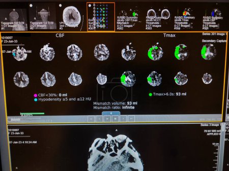 Brain Perfusion Imaging - Cerebral Angiography - Color