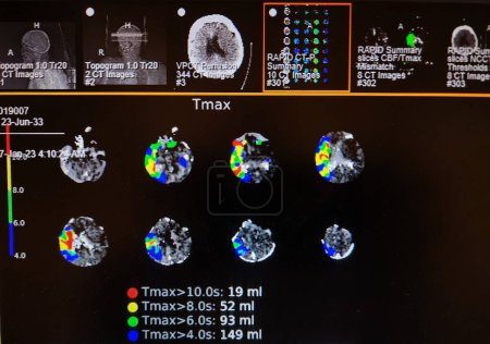 Imágenes de perfusión cerebral - Angiografía cerebral - Color