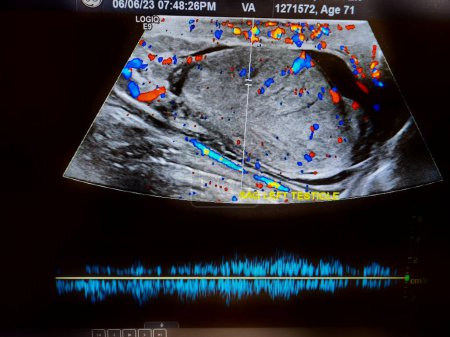 Téléchargez les photos : Échographie testiculaire montrant un flux sanguin normal - en image libre de droit