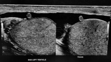 Testicular ultrasound showing normal bloodflow