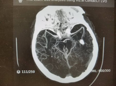 angiographie CT - tête et cerveau