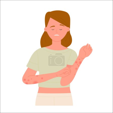 Illustration for Girl scratching hands covered with red rash. Skin allergic reaction, atopic dermatitis vector flat illustration - Royalty Free Image