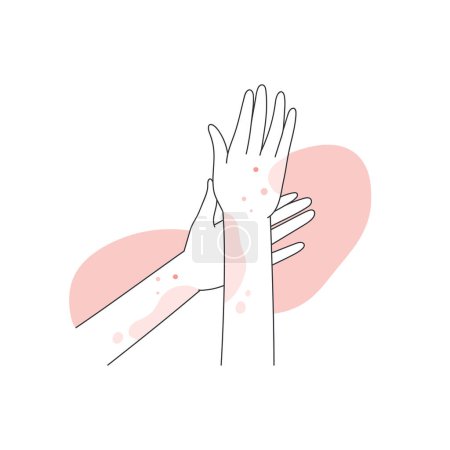 Illustration for Human hands covered with red rash. Allergic reaction on hands, atopic dermatitis line vector illustration - Royalty Free Image