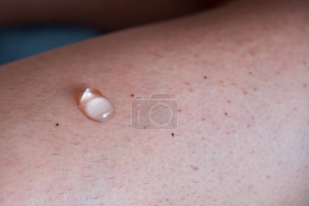 Photo for A large drop of anti-inflammatory healing cream on the leg. Treatment of arthrosis and arthritis, anti-inflammatory ointment for the treatment of joints, close-up, - Royalty Free Image