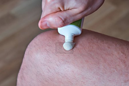Téléchargez les photos : Un homme presse de la crème anti-inflammatoire d'un tube sur sa jambe. Traitement de l'arthrose et de l'arthrite, pommade anti-inflammatoire pour le traitement des articulations, gros plan - en image libre de droit