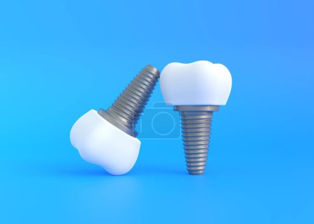 Téléchargez les photos : Implants dentaires sur fond bleu. Concept d'examen dentaire dents, santé dentaire et hygiène. Illustration de rendu 3D - en image libre de droit