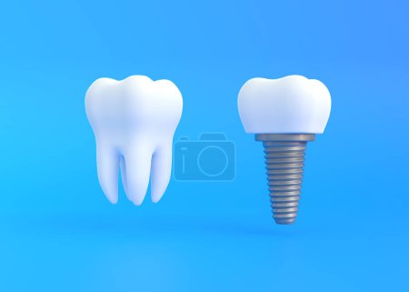 Photo for White tooth and dental implant on a blue background. Concept of dental examination teeth, dental health and hygiene. 3d render illustration - Royalty Free Image