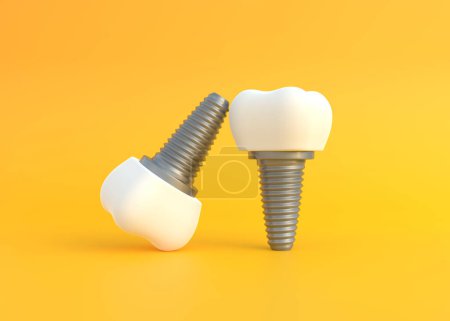 Téléchargez les photos : Implants dentaires sur fond jaune. Concept d'examen dentaire dents, santé dentaire et hygiène. Illustration de rendu 3D - en image libre de droit